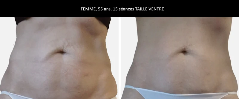 LPG SPECIAL VENTRE 20 MIN - pack de 5 séances 