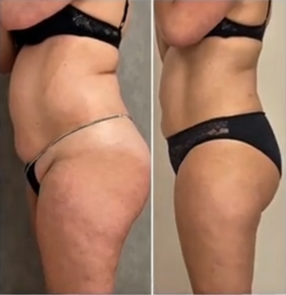 Séance découverte LPG Cellu M6 