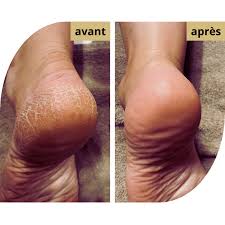 CALLUSPEELING - SOIN PIEDS ANTI-CALLOSITES
