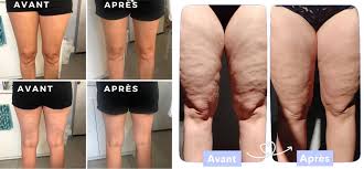 PRESSOTHERAPIE - DRAINAGE/JAMBES LEGERES - pack de 5 séances