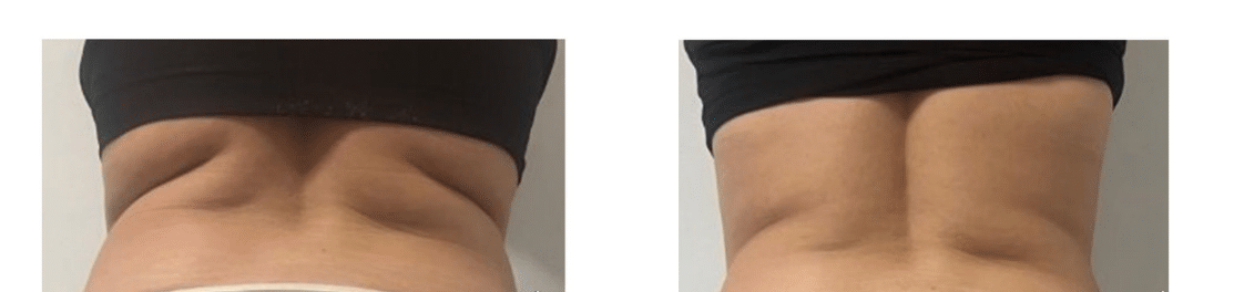 CELLU M6 - LPG 30MIN - DESTOCKE - AFFINE - CELLULITE - pack de 5 séances
